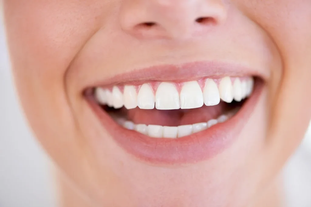 beneficios del blanqueamiento dental