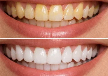 blanqueamiento dental tudela