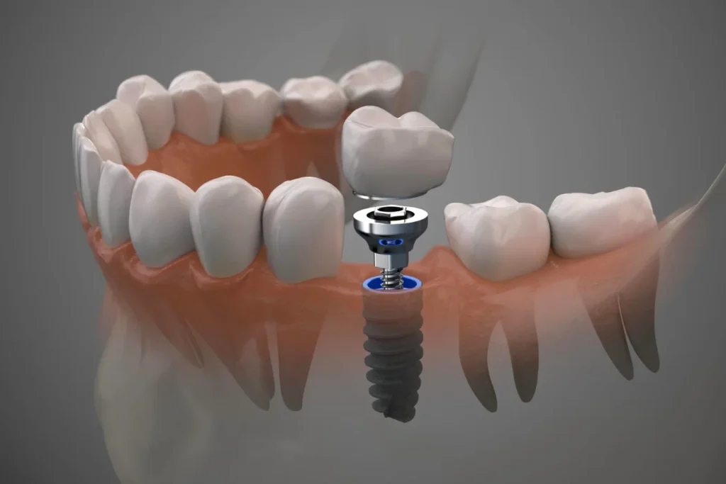 implantes dentales tudela