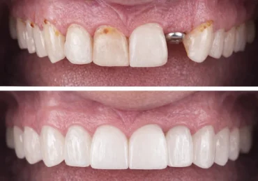implantes dentales tudela
