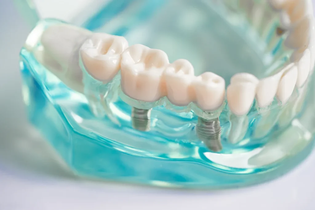 planificación del tratamiento de implantes dentales