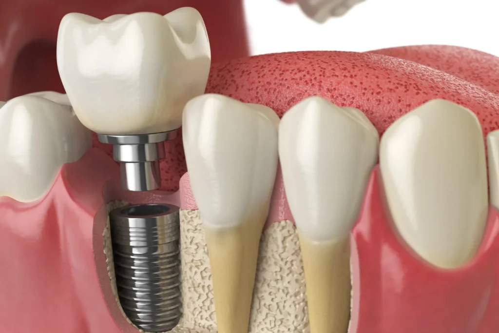Rehabilitación protésica sobre implantes