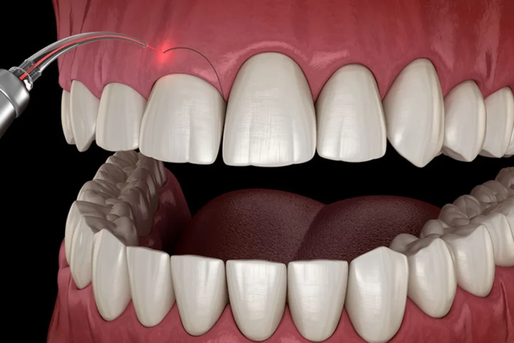 gingivectomia en tudela