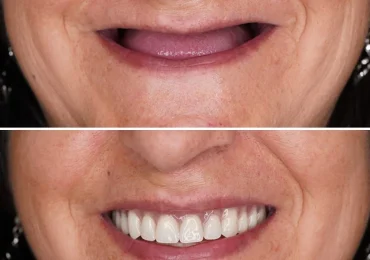prótesis dentales