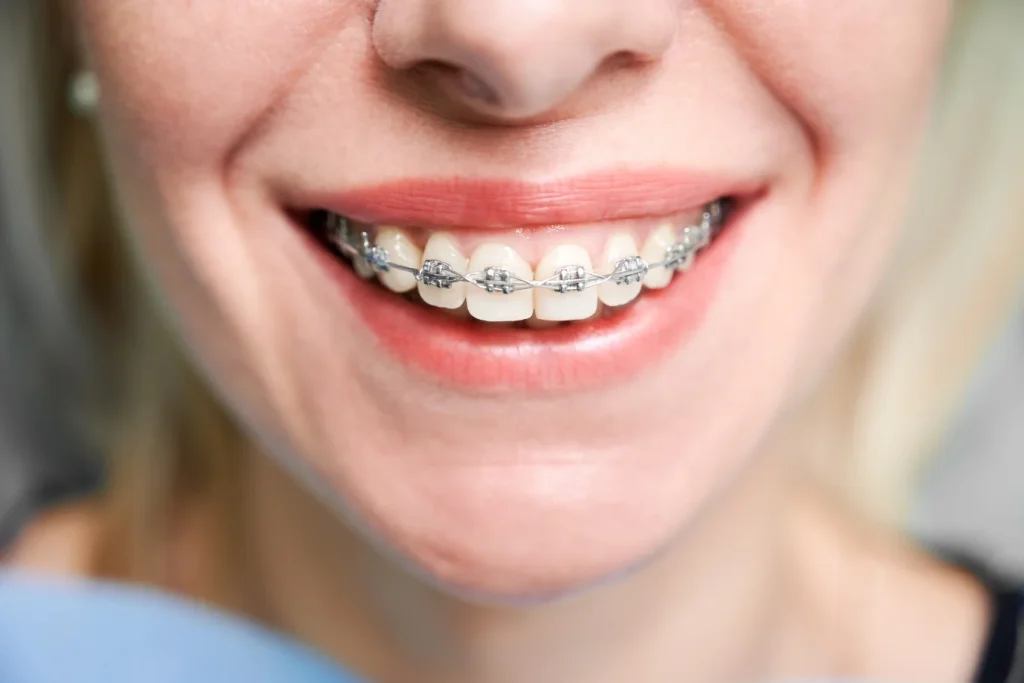 tratamientos de brackets para adultos y niños en tudela