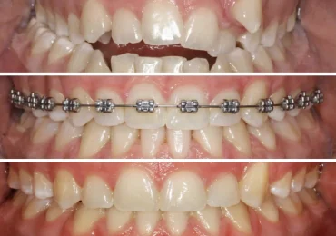 brackets tudela
