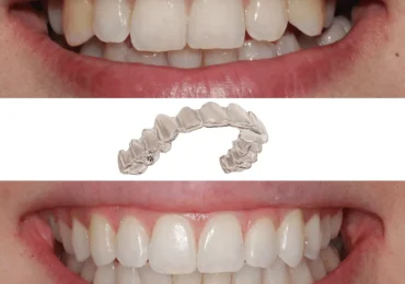 invisalign tudela