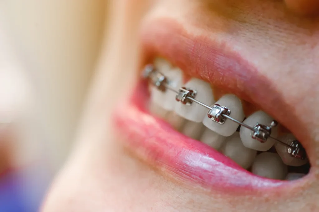 que problemas solucionan los brackets